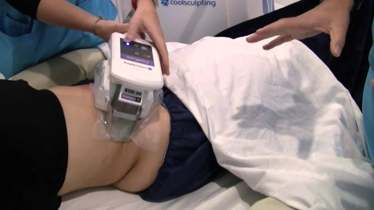 CoolSculpting Lower Abdomen Freeze Fat in Los Angeles ...