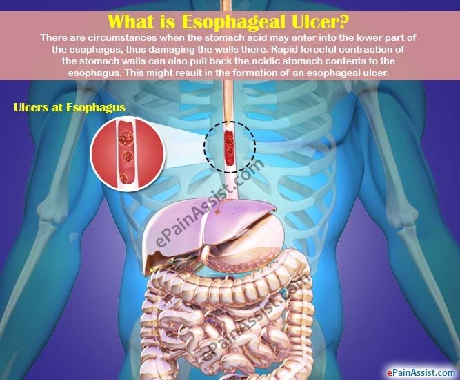 Esophageal Ulcer
