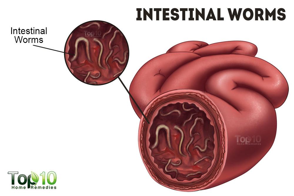 Home Remedies for Intestinal Worms