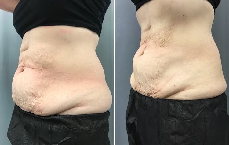 How Does Coolsculpting Work?