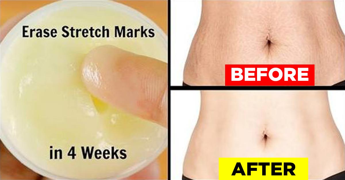 reduce appearance of stretch marks iammrfoster com