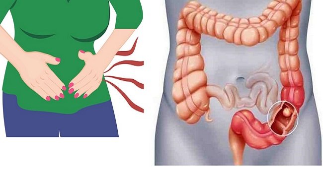The Main Signs Your Bloating and Stomach Pain Is a Sign of ...
