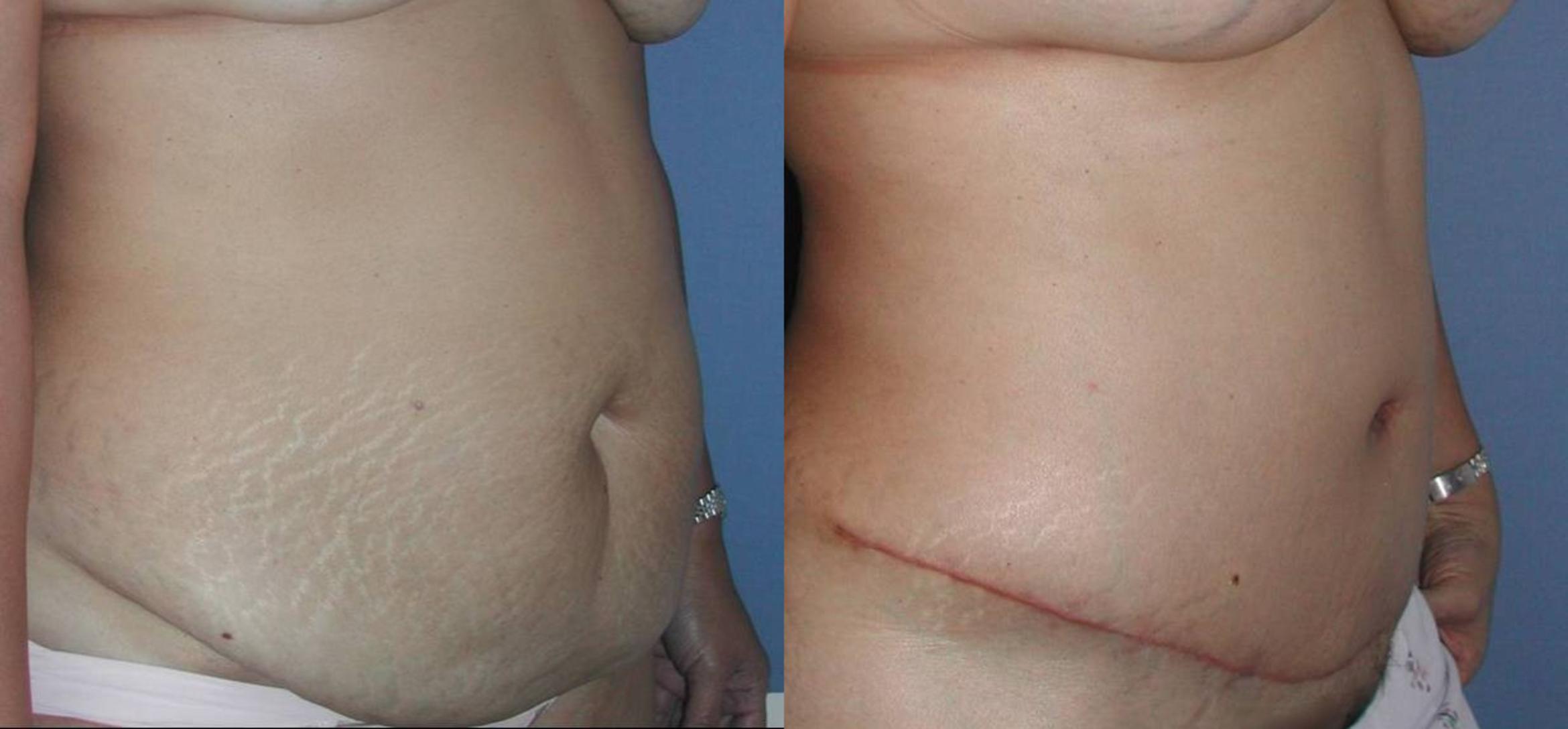Tummy Tuck Before &  After Photos Patient 33