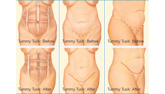 Tummy Tuck Plastic Surgery