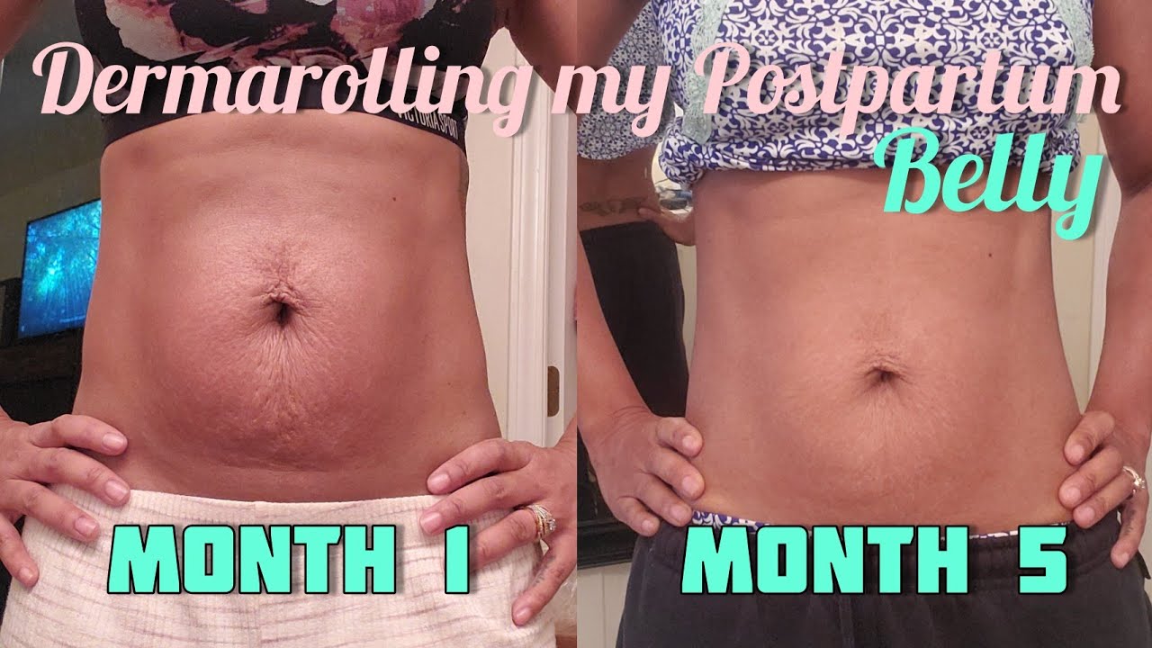 I tried Dermarolling my Postpartum Belly + Month 5 Update ...