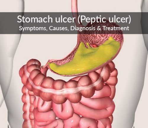 Stomach ulcer (Peptic ulcer) : Symptoms, Causes, Diagnosis ...