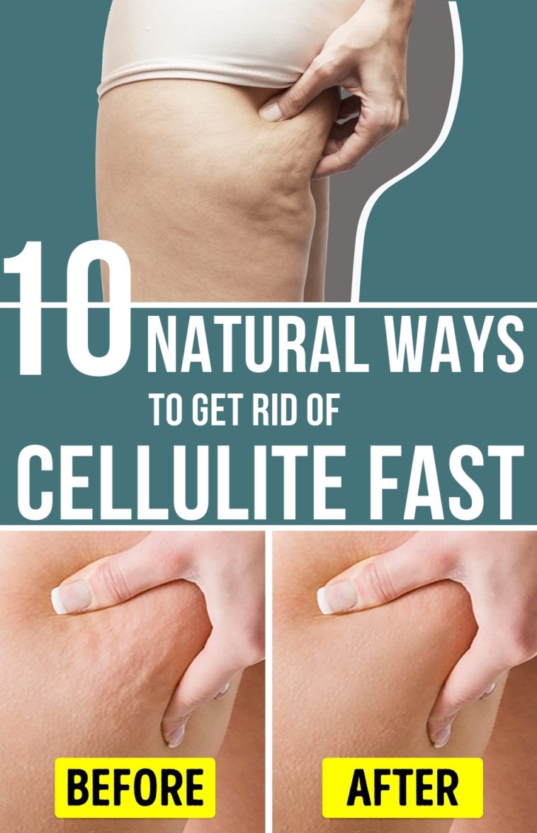 10 Natural Ways To Get Rid Of Cellulite Fast