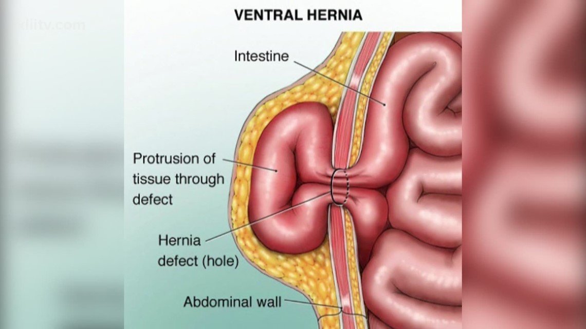 Abdominal wall hernias