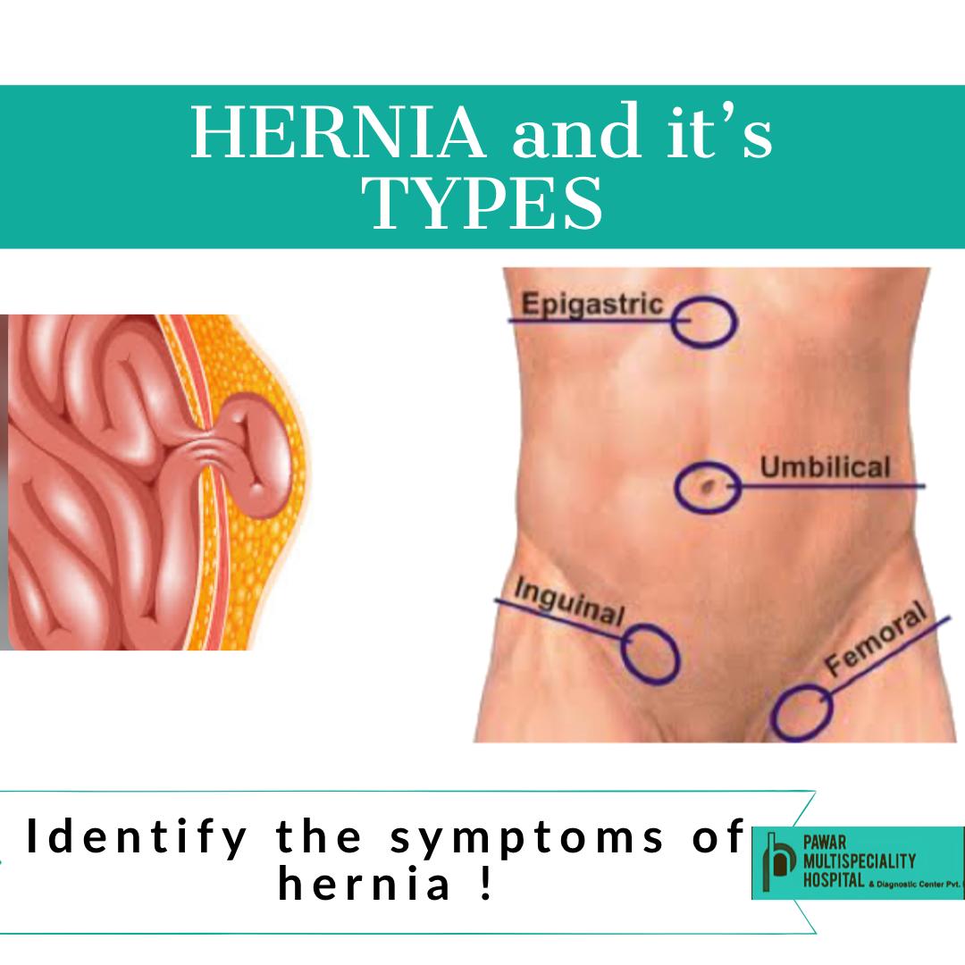 Hernia in most cases occurs as a painless swelling in any ...