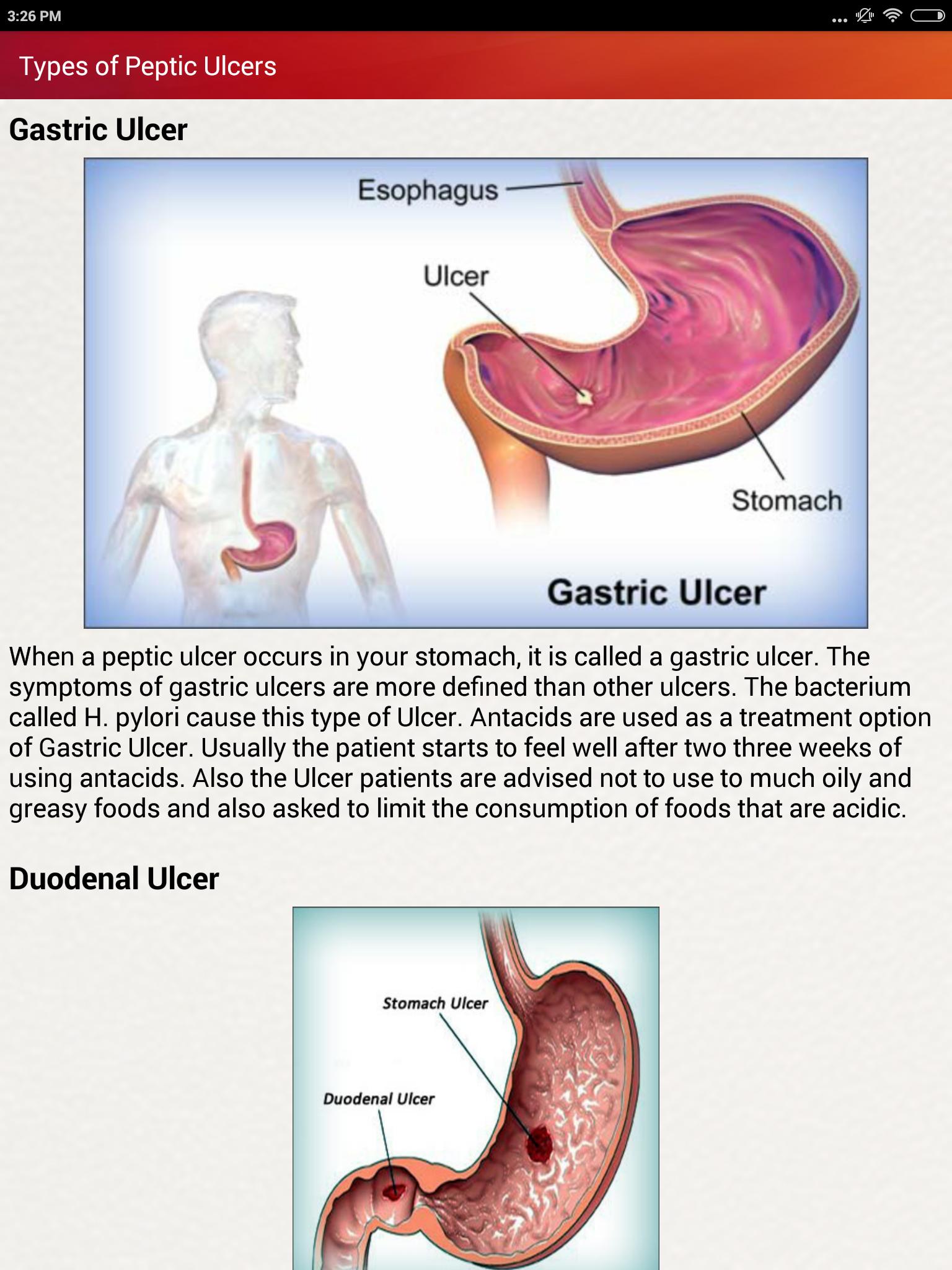 Peptic Ulcers Treatment &  Help for Stomach Ulcers for Android