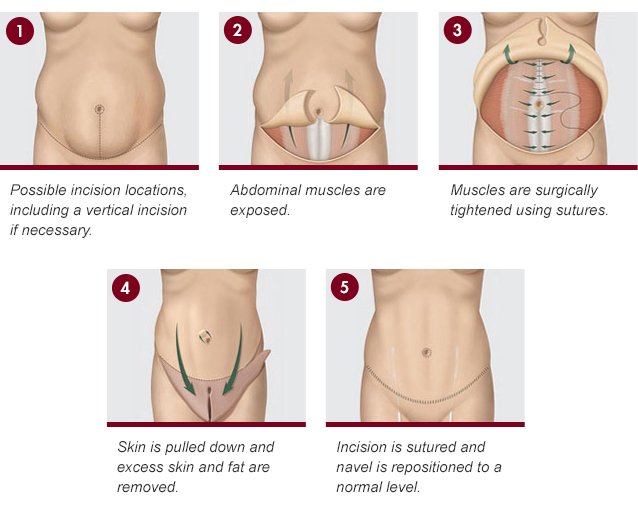 Tummy Tuck (Abdominoplasty): Procedure, Risks, and Cost