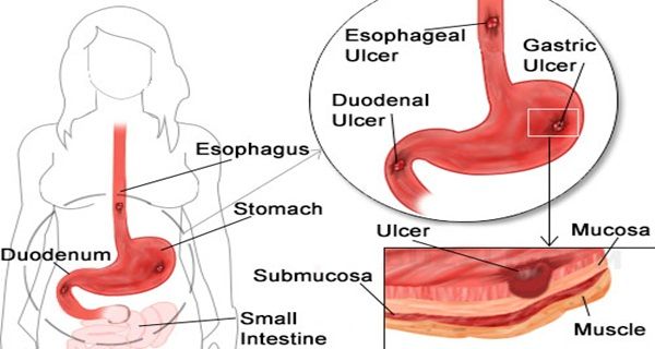 8 Critical Signs That You Have Stomach Ulcers And What To Do About It ...
