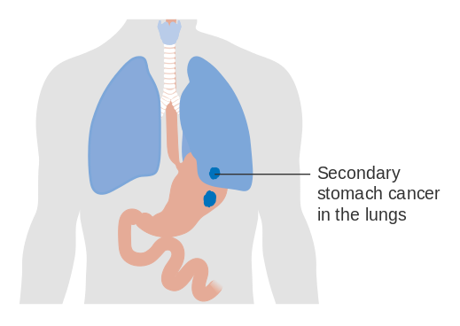 Cancer Of The Stomach And Lungs