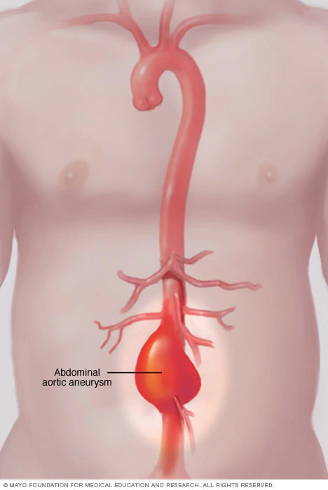 What is the best way to screen for an abdominal aortic aneurysm?