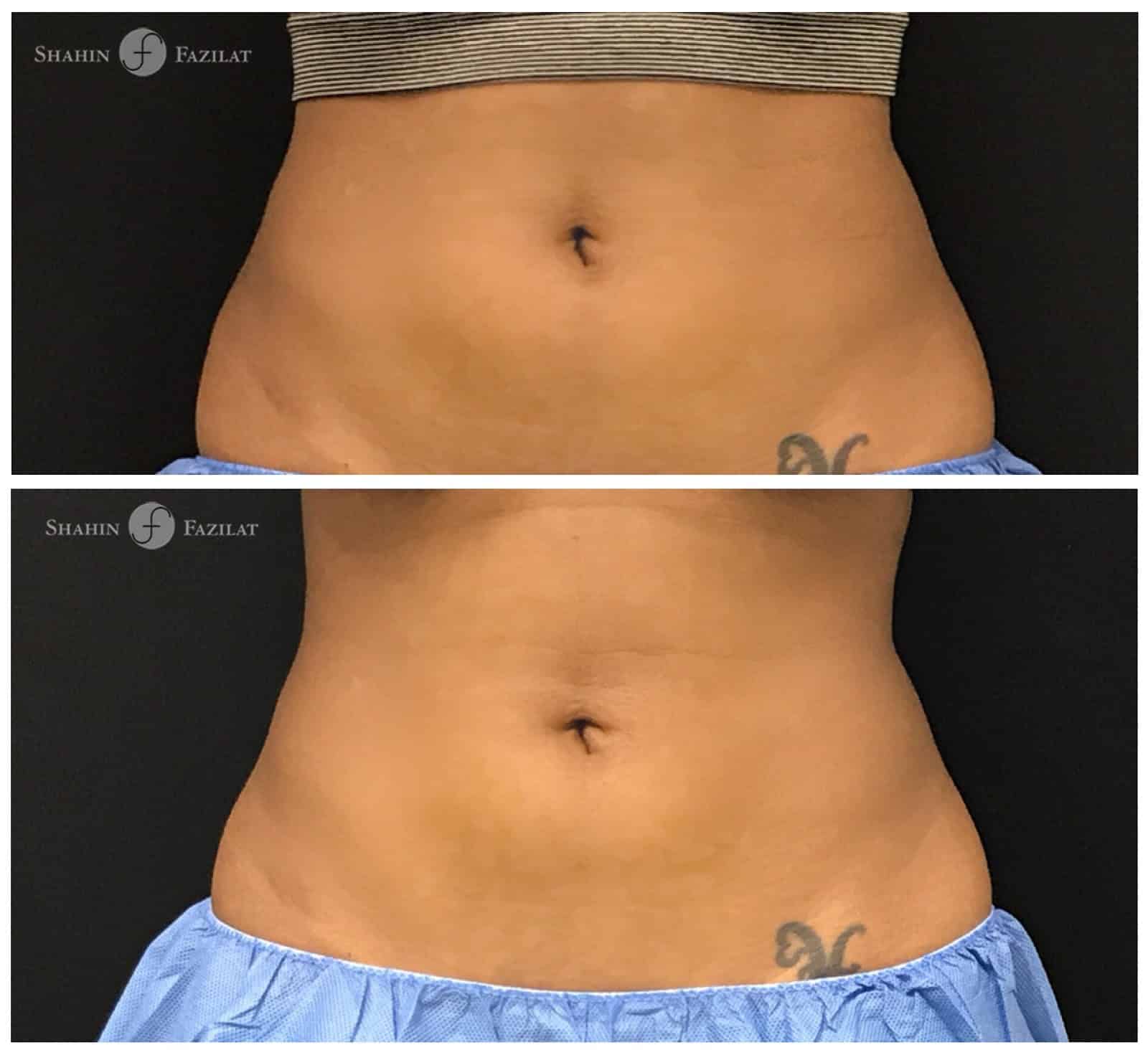 My CoolSculpting Story