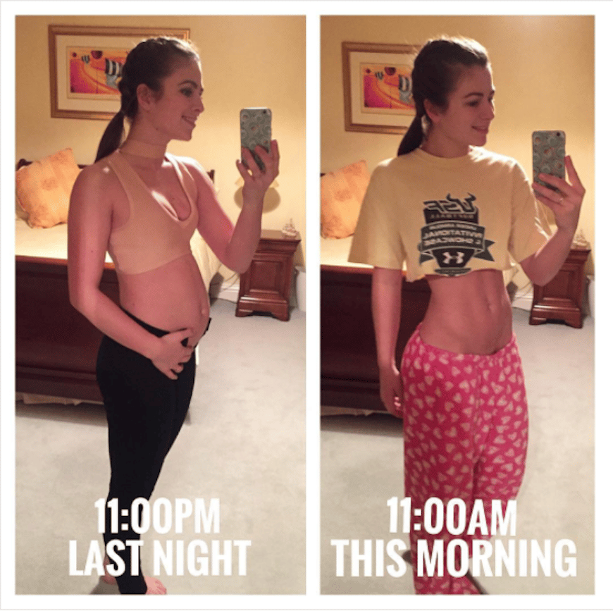 13 Women Showing Their Bloated Bellies To Prove Extreme Bloating
