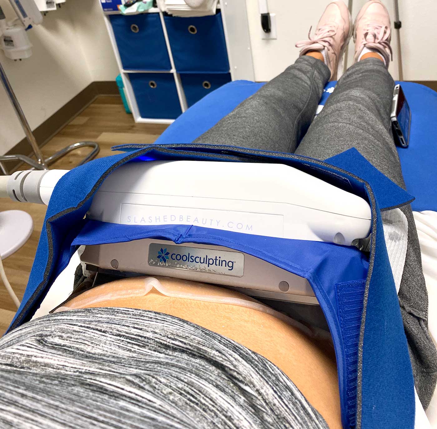 Coolsculpting Experience: Lower Belly &  Love Handles