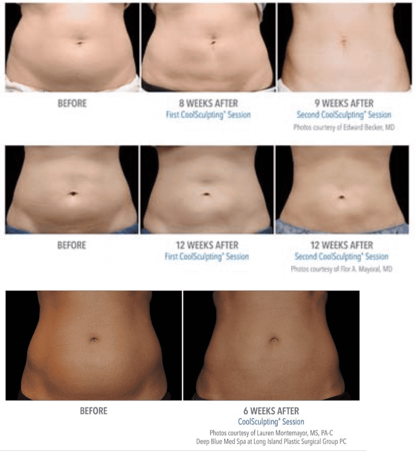 Coolsculpting On Abdomen: PureLee Redefined: Medical Aesthetics