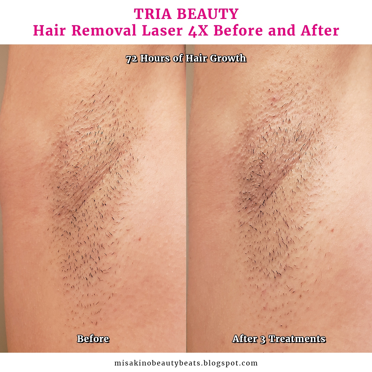 Tria Hair Removal Before And After
