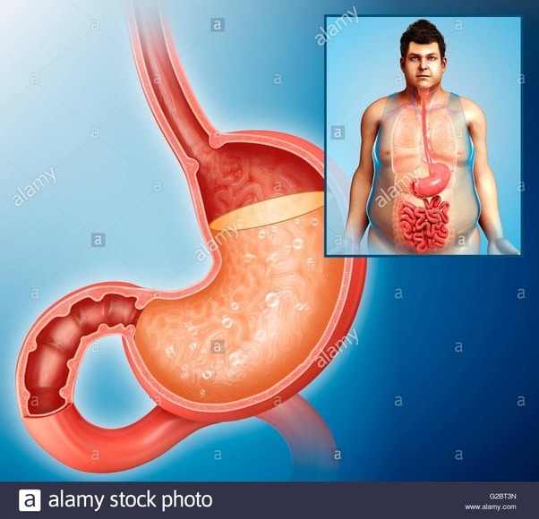 How does acidity occur in stomach?