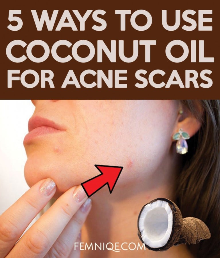How To Use Coconut Oil For Acne Scars (5 Ways)