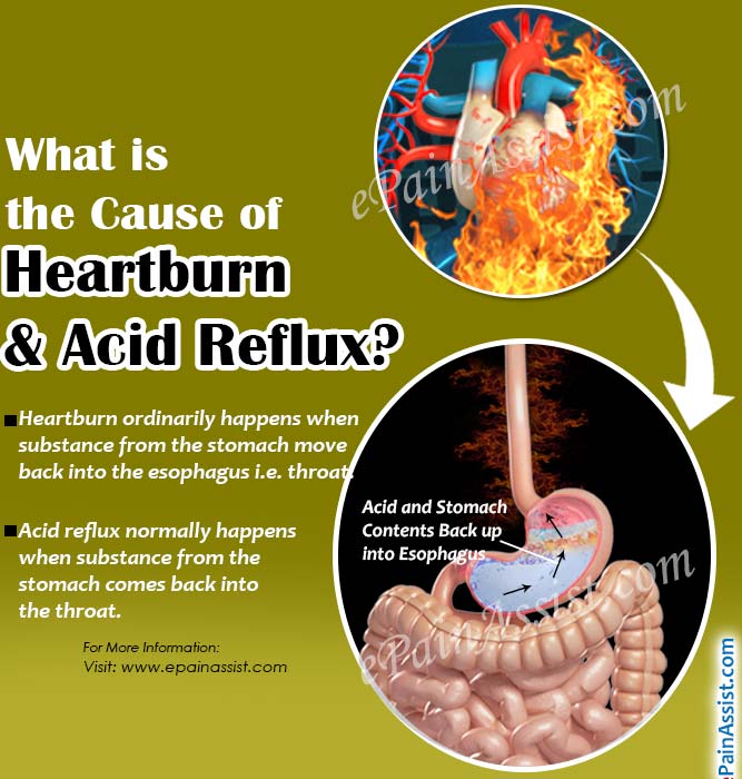 Know about Causes of Acid Reflux ~ Msb
