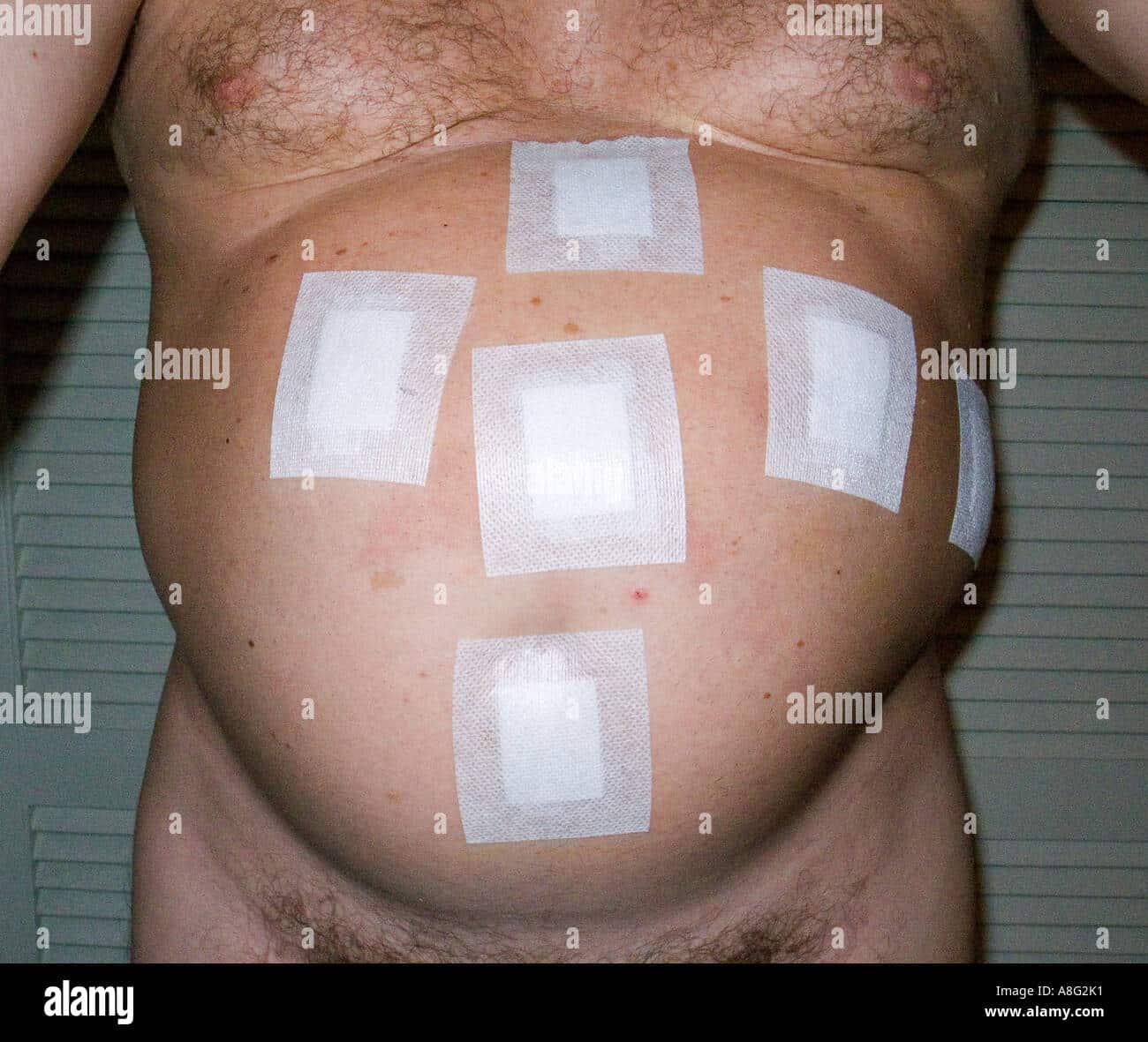The postoperative distended belly of a man who has undergone Stock ...