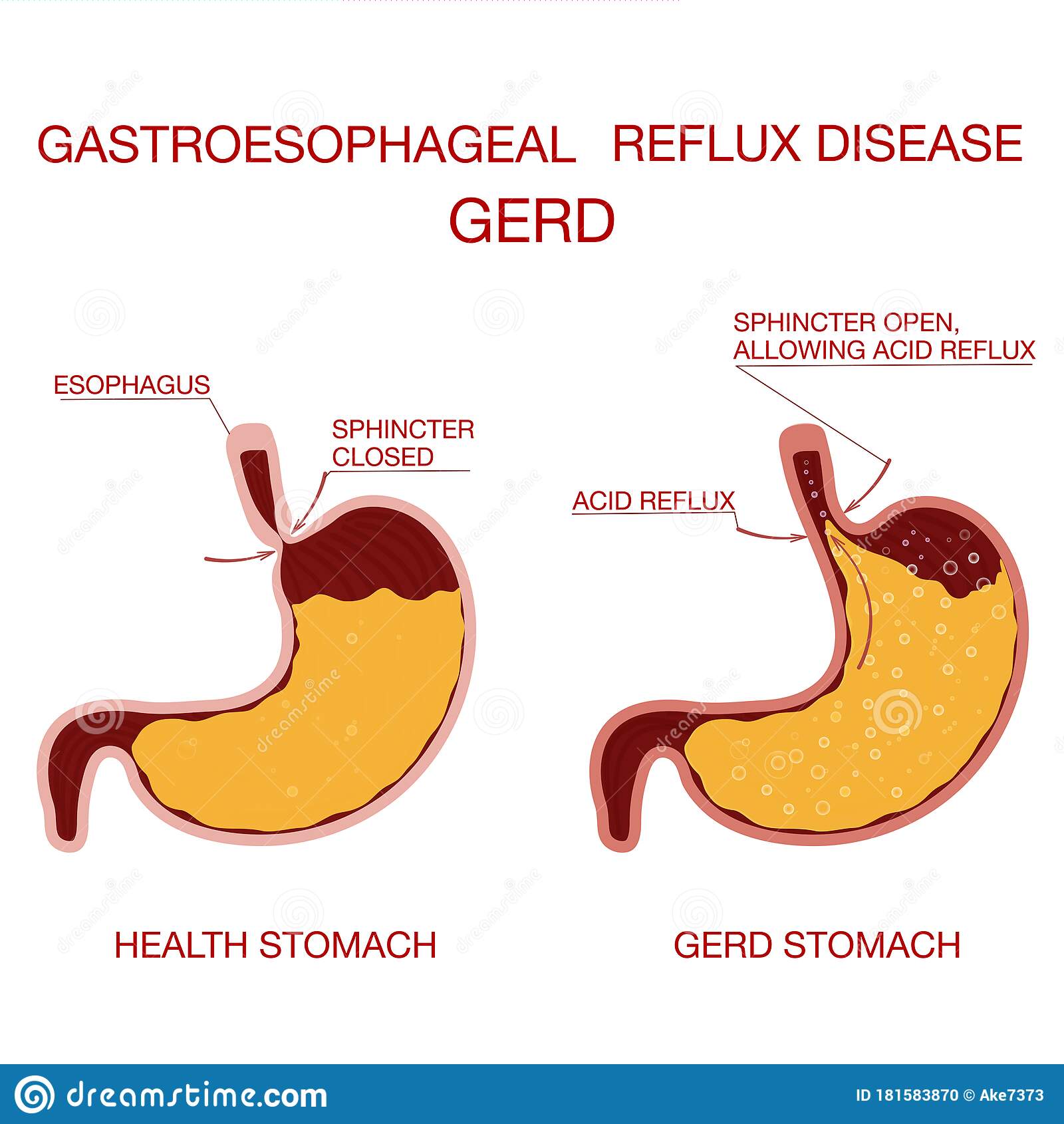Acid Reflux Heartburn And Gerd Infographic Stock Photo