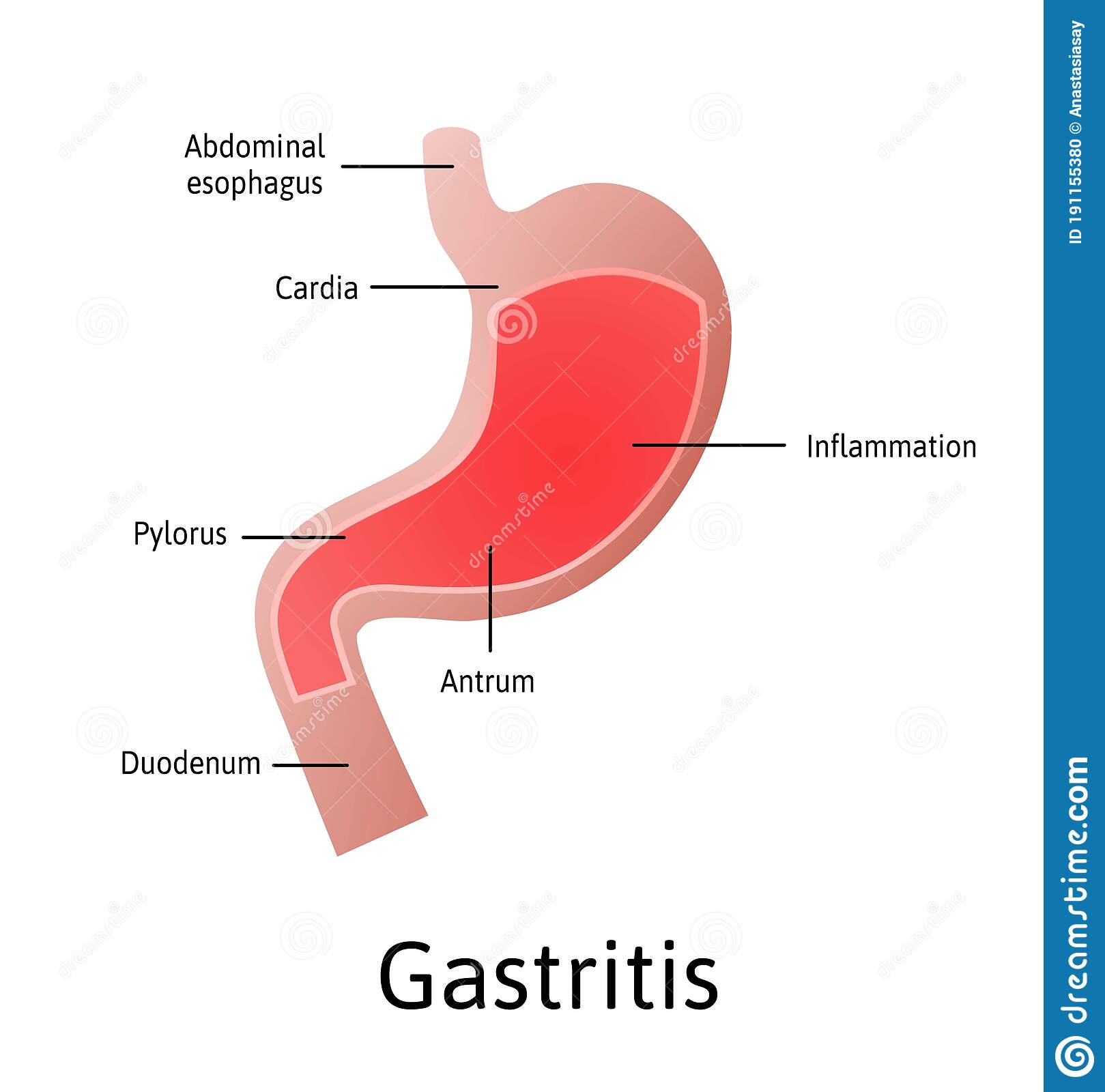 Gastritis, an Inflammation, Irritation, or Erosion of the Lining of the ...